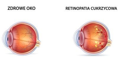 Retinopatia cukrzycowa